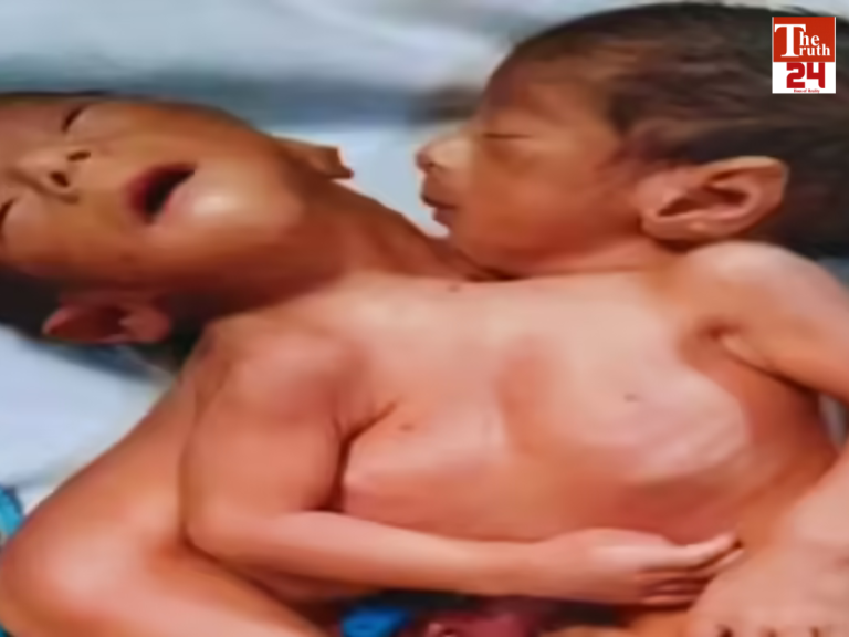 conjoined twins birth and mother death Aligarh rare case
